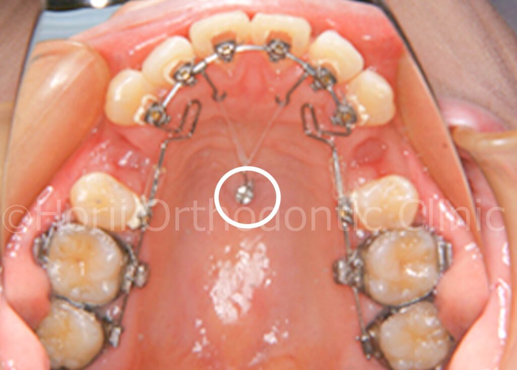 歯科矯正用アンカースクリューを用いた矯正治療とは？|滋賀の矯正歯科ポータルサイト「オルソキャリア」