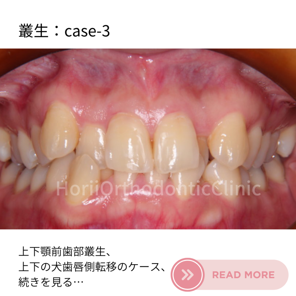 舌側矯正治療例、上下顎前歯部叢生、ほりい矯正歯科クリニックの症例