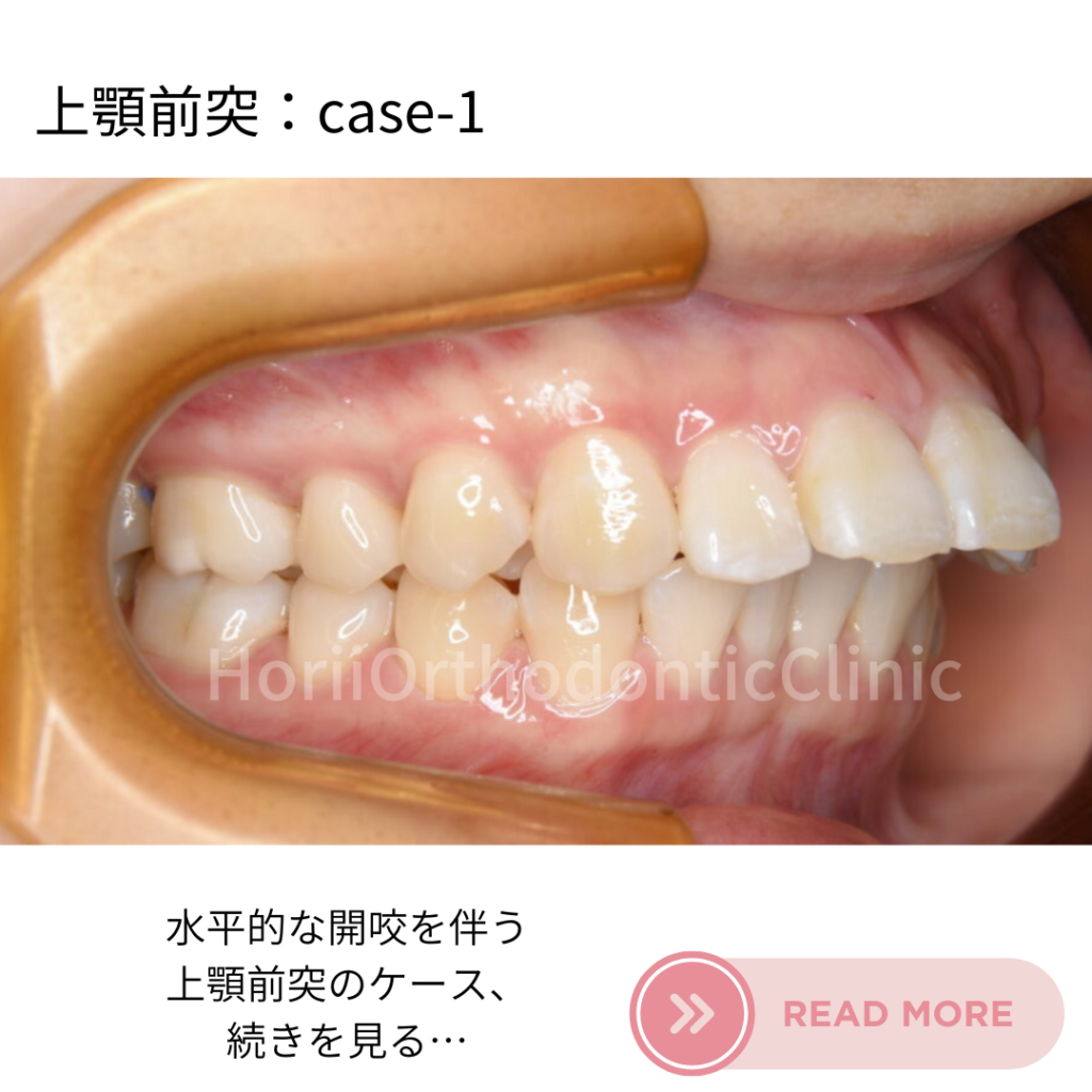滋賀ほりい矯正歯科クリニックの舌側矯正治療症例、水平的な開咬を伴う上顎前突のケース