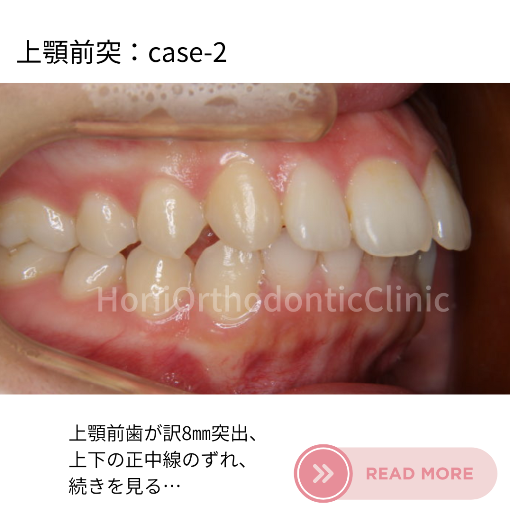 滋賀ほりい矯正歯科クリニックの舌側矯正治療症例、上がk前歯が突出、上下の正中線がズレているケース