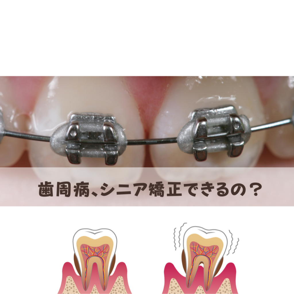 滋賀の矯正情報オルソキャリアのブログ記事、重度の歯周病はシニア矯正できる？